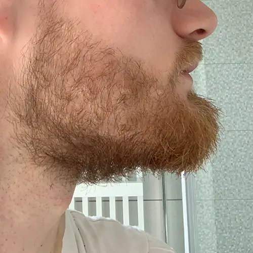 Bart nadat hij de finez baardgroei kit heeft gebruikt